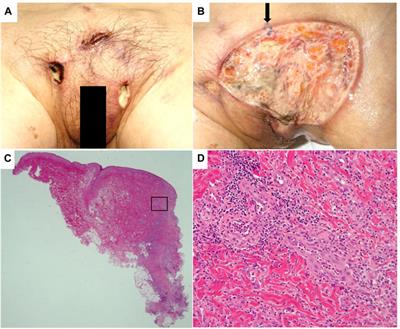 Pyoderma gangrenosum of the mons pubis associated with aplastic anemia